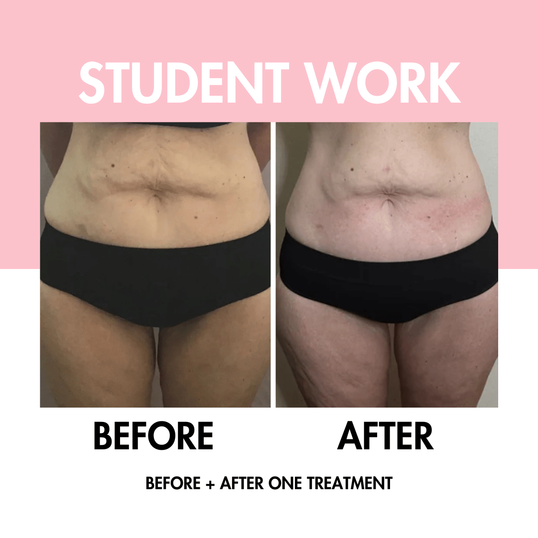 Body Contouring Online Course - BBL | Fat Cav | RF Skin Tightening