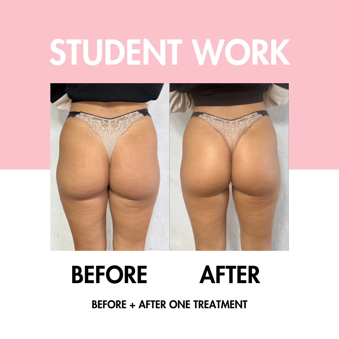 Body Contouring Online Course - BBL | Fat Cav | RF Skin Tightening