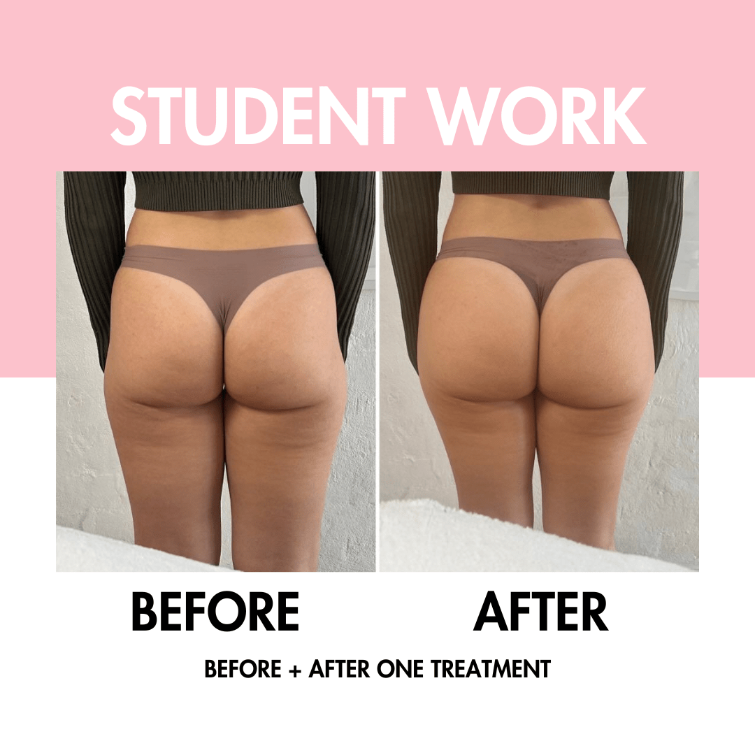 Body Contouring Online Course - BBL | Fat Cav | RF Skin Tightening