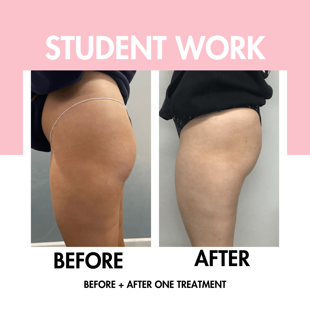 Body Contouring Online Course - BBL | Fat Cav | RF Skin Tightening