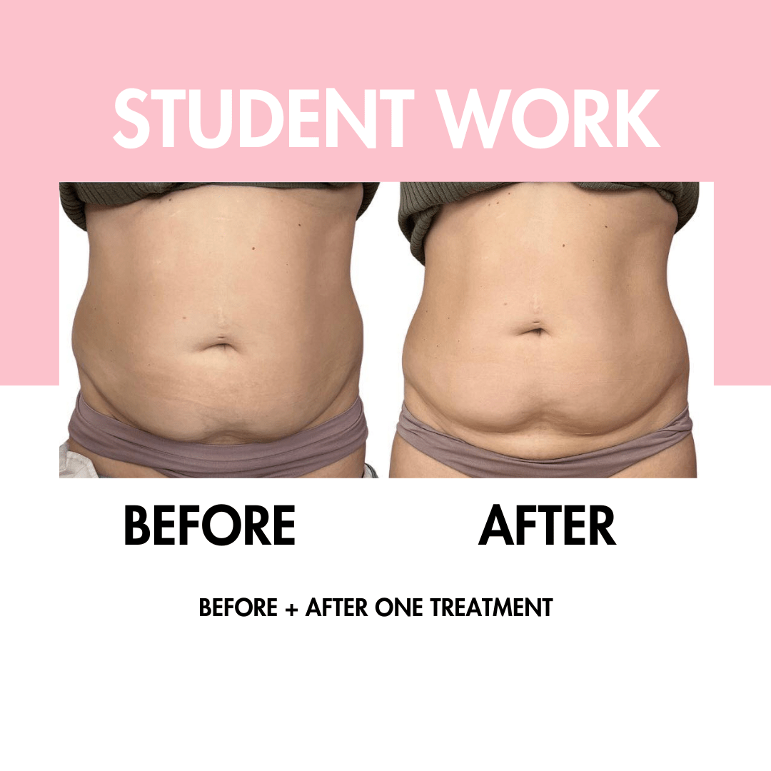 Body Contouring Online Course - BBL | Fat Cav | RF Skin Tightening
